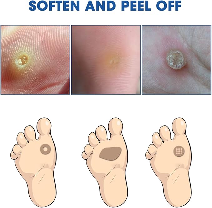 Liquid Corn Remover, Corn Removers for Toes, Fast Acting, Safe Removes Corns Fast Extra Strength for Kids and Adults, 15ml Liquid with 15PCS Cushions 10PCS Swabs (15ML*1)