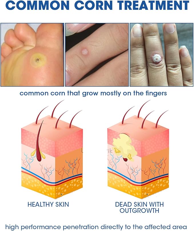 Liquid Corn Remover, Corn Removers for Toes, Fast Acting, Safe Removes Corns Fast Extra Strength for Kids and Adults, 15ml Liquid with 15PCS Cushions 10PCS Swabs (15ML*1)