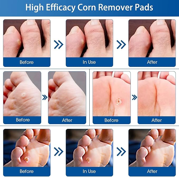 48 Count Corn Removal Pads for Feet and Toe, Corn Feet Remover for Extra Strength, Callous Remover